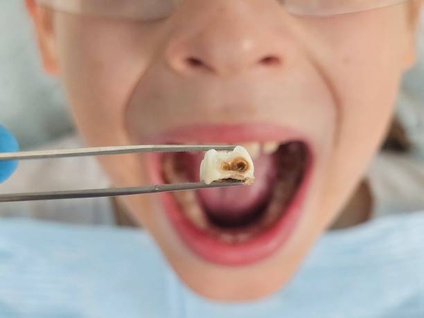 Best Emergency Treatment for Dental Infections or Abscesses in Newk, AR